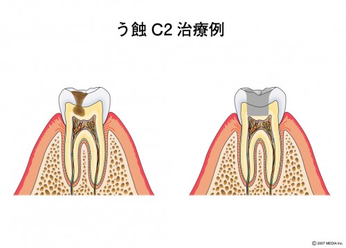 むし歯　C2